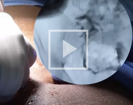 VIDEO: Percutaneous Insertion Technique of a Peritoneal Dialysis Catheter