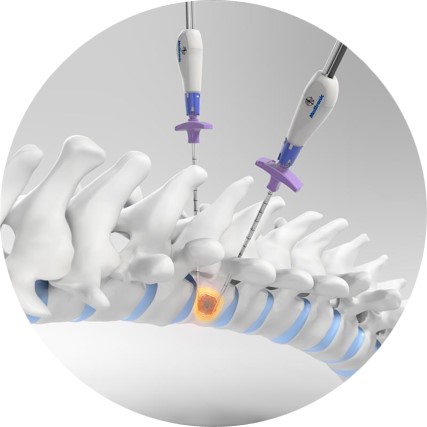 OsteoCool™ RF ablation