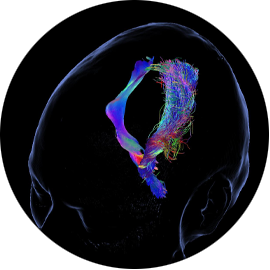 Stealth™ Tractography soluciones Medtronic spine para cirugía de cráneo